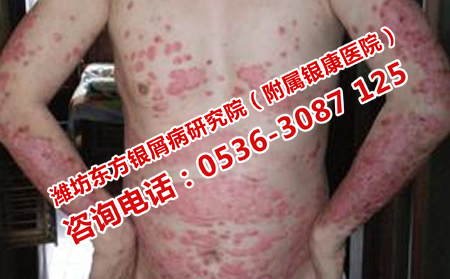 為什么銀屑病病情不穩(wěn)定