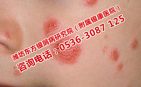 遺傳病初發不嚴重的治療