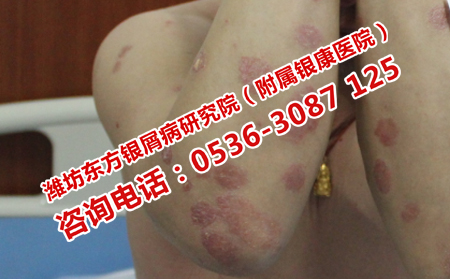 膿皰型牛皮癬應該怎樣治療