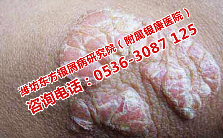 治牛皮頑癬的一般步驟