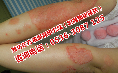 兒童得了牛皮癬應該去哪家醫院接受治療