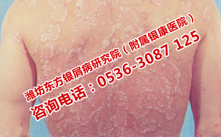 怎樣全面護(hù)理牛皮癬