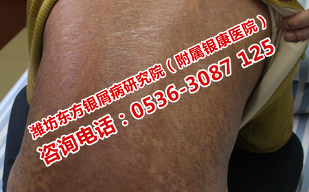 得了牛皮癬吃點什么可以