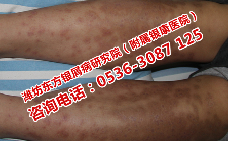 怎么治療牛皮癬可以