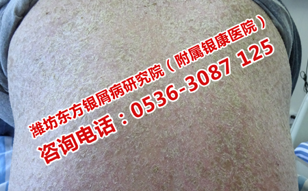 牛皮癬患者能不能喝茶水