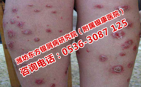 剛得的牛皮癬怎么治療好