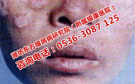 女性面部的牛皮癬夏天的護理