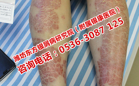 牛皮癬患者日常應該注意什么