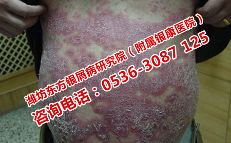 導致牛皮癬發病的內因