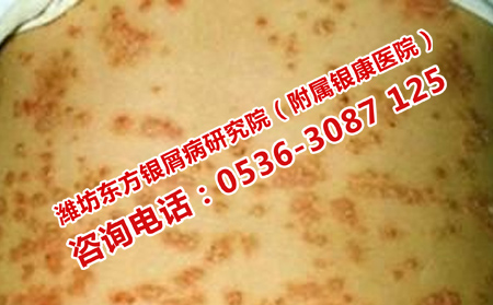 牛皮癬患者不能吃什么