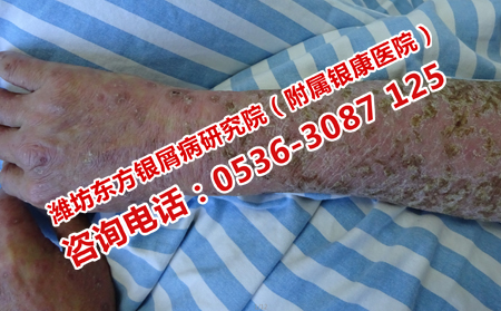 牛皮癬患者喝酒的后果是什么