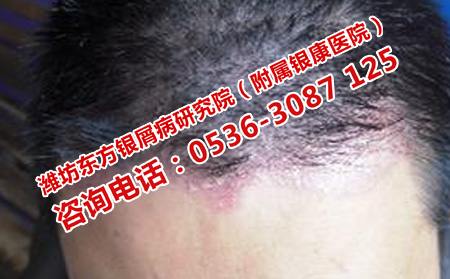 牛皮癬脫發如何進行護理