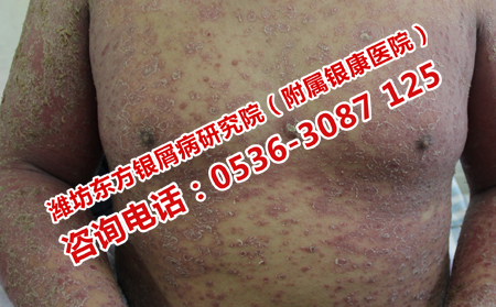 濰坊牛皮癬怎樣治療效果好