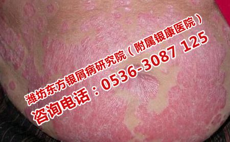 身體素質差得了牛皮癬怎么辦