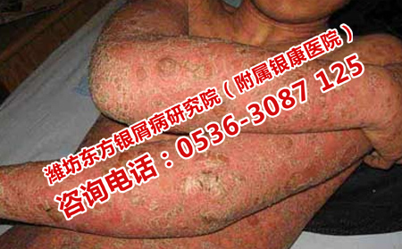 怎樣使牛皮癬夏季不發(fā)作