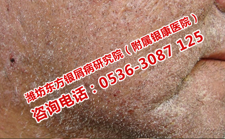 哪些牛皮癬病因是可以控制的