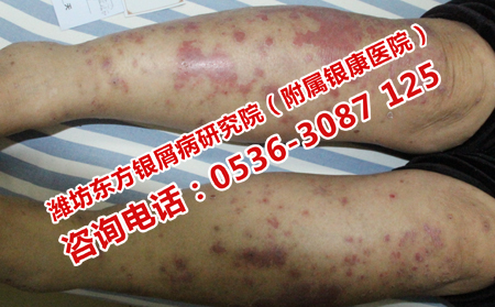 牛皮癬患者在日常需要注意什么