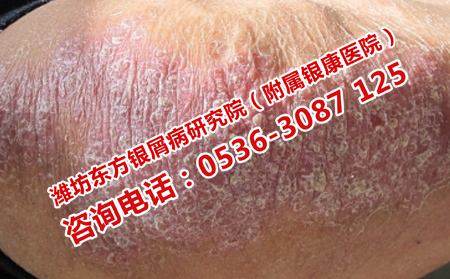 牛皮癬為什么復發性高