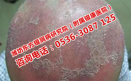 多年牛皮癬患者要預防的危害