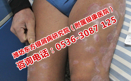 多年牛皮癬有什么治療技巧