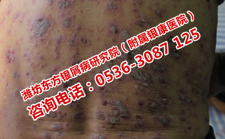 得了牛皮癬如何高效的擺脫