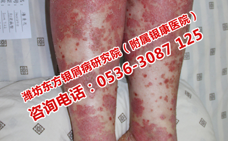 治療牛皮癬注意事項有哪些