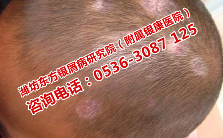 夏季如何護理孩子頭部的牛皮癬