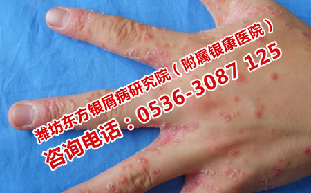 手部牛皮癬難以恢復的原因