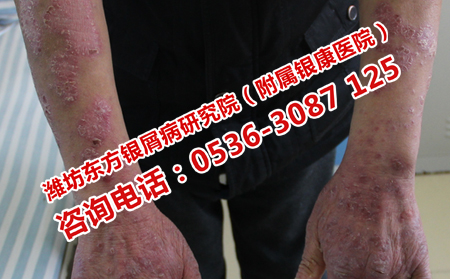 哪些習(xí)慣會(huì)導(dǎo)致牛皮癬發(fā)生