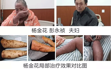 銀屑病癥狀對比圖片