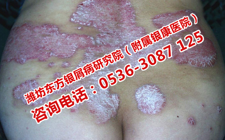 為什么牛皮癬秋天復發