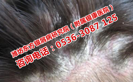 護理牛皮癬的新招