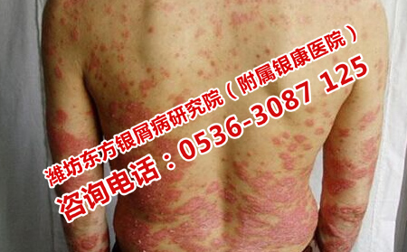 牛皮癬患者如何度過秋天