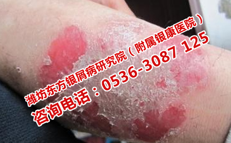 青州看銀屑病醫院