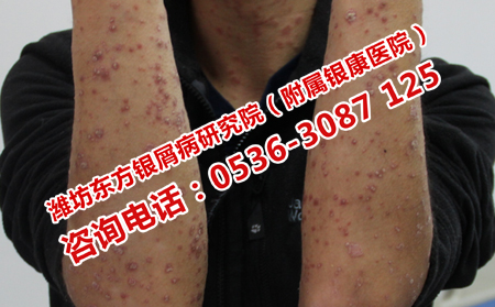 恢復治療牛皮癬的方法