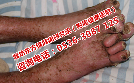 牛皮癬上哪里治療好得快