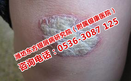 銀屑病纏身不恢復的原因