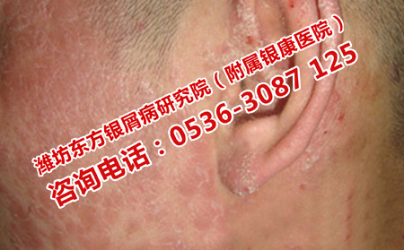 頭部銀屑病的護理方法