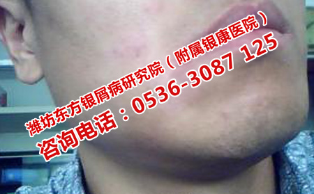 世界銀屑病日疾病說明