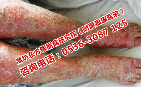 銀屑病秋季復發的原因