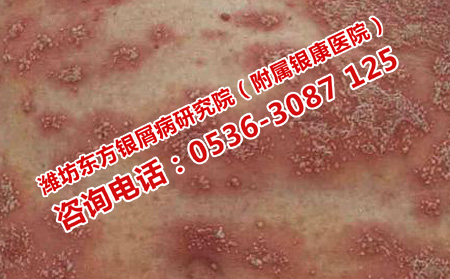 銀屑病加重的原因