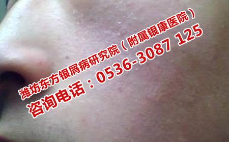 寒冷天氣的牛皮癬如何護膚