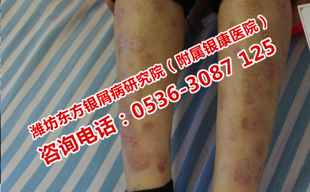怎樣治療減少銀屑病進程