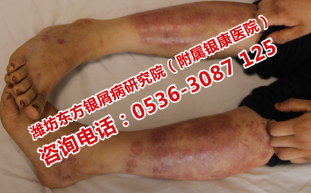 秋冬護理關節型銀屑病