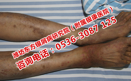 治療牛皮癬的關(guān)鍵點(diǎn)