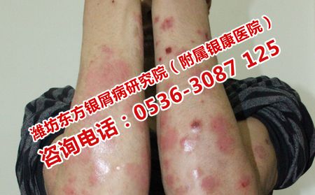 預防安丘銀屑病復發的方法