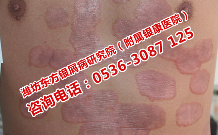 去濰坊哪里看銀屑病可以