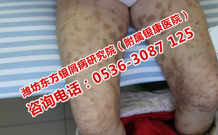 寒冷時期的銀屑病預防辦法