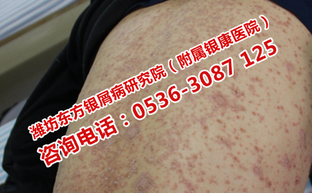 尋常型銀屑病的圖片
