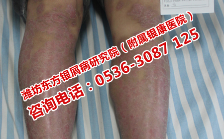 銀屑病治不好的原因是什么